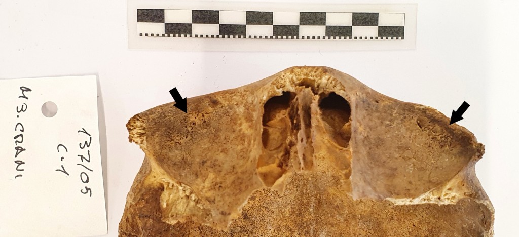 Inferior view of the frontal bone of a young adult male individual from the post-medieval cemetery of Sant Cugat del Rec (Barcelona). At the roof of the eye orbits, it shows a cluster of porous of less than a millimeter in diameter diagnosed as cribra orbitalia. 